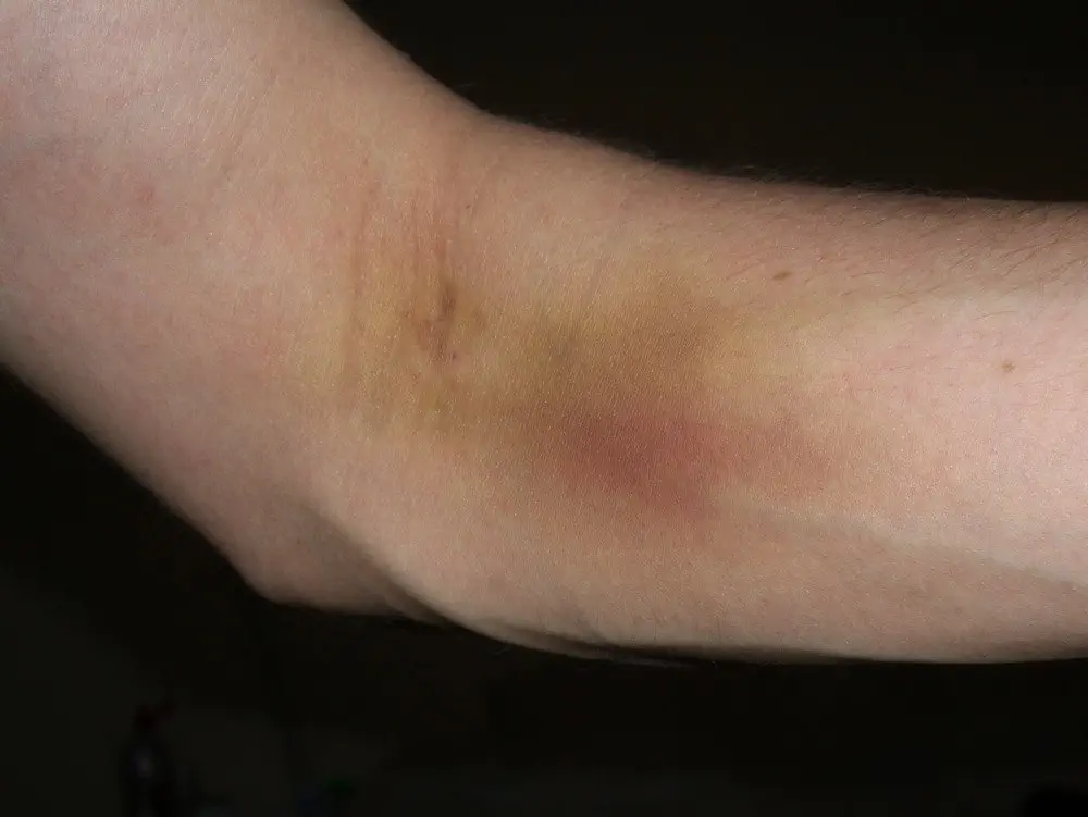 Image credit: https://diplycom5cc47.zapwp.com/q:i/r:0/wp:1/w:1/u:https://commons.wikimedia.org/wiki/File:Blood_donation_bruise.jpg