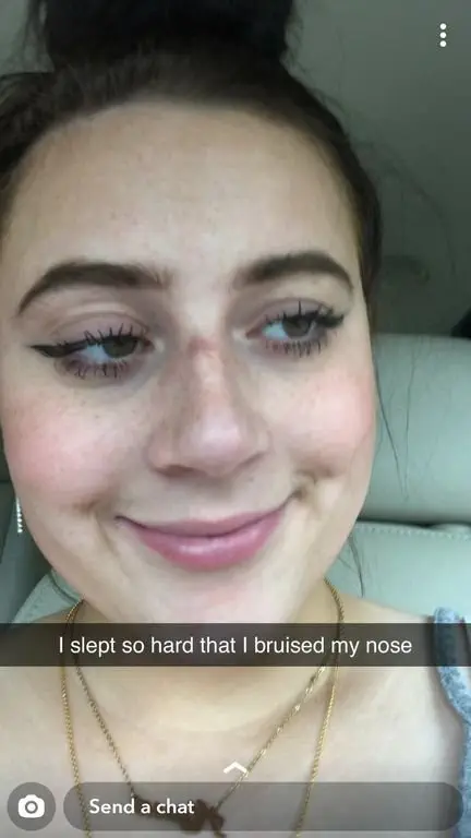 Girl with bruised nose (Image credit: Reddit | Junopoped)