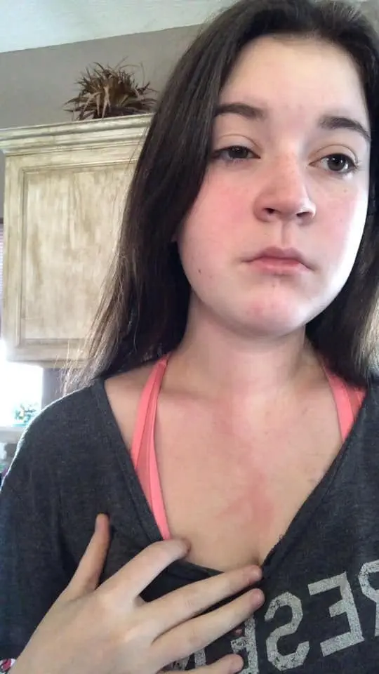 Image credit: Facebook | McKenze Messman Fight with Ehlers Danlos, POTS, and Mast Cell Disease