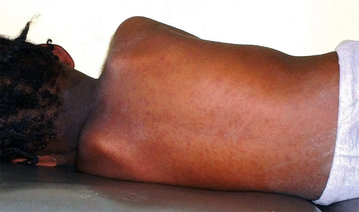 Image credit: https://diplycom5cc47.zapwp.com/q:i/r:0/wp:1/w:1/u:https://commons.wikimedia.org/wiki/File:Measles_in_African_Child_3.JPG