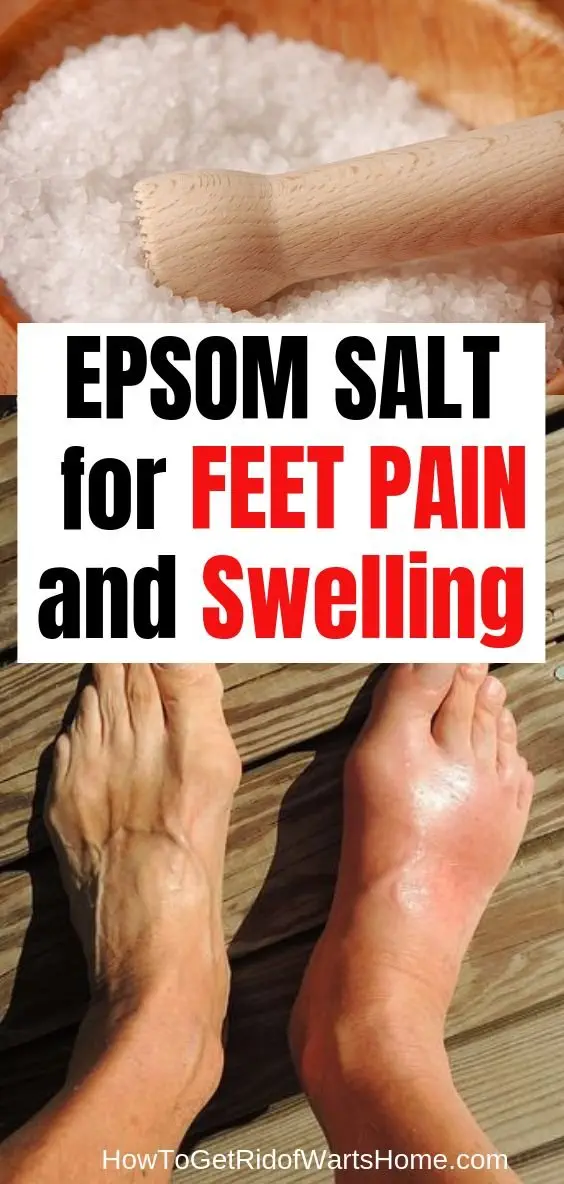 Image credit: How To Get Rid Of Warts Home