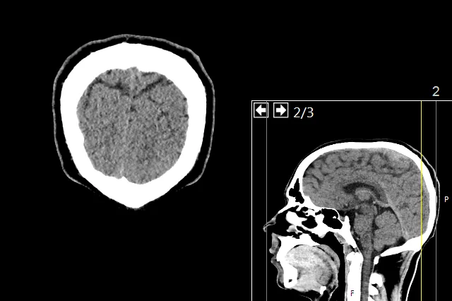 Image credit: https://diplycom5cc47.zapwp.com/q:i/r:0/wp:1/w:1/u:https://commons.wikimedia.org/wiki/File:CT_of_a_normal_brain,_coronal_53.png